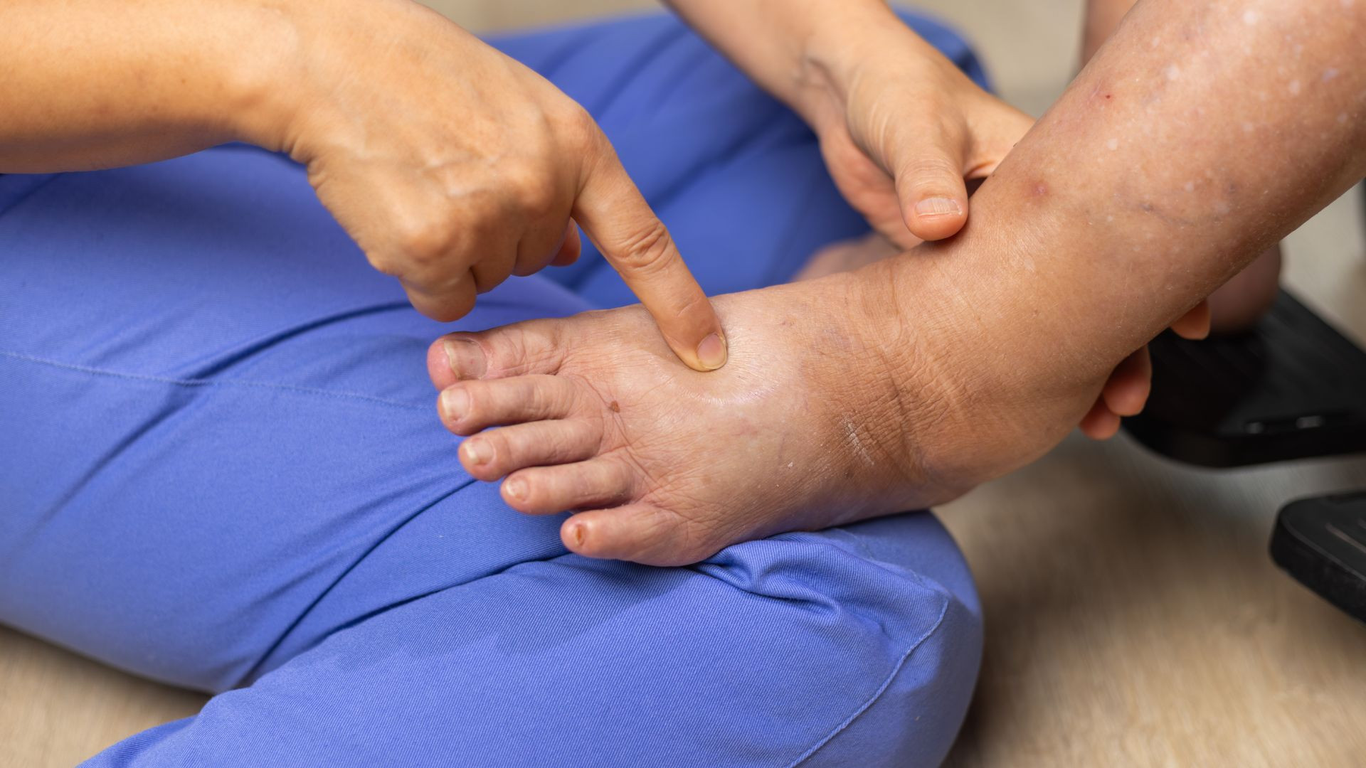 Il piede diabetico: come proteggerlo ogni giorno con cura e la scarpa giusta Il piede diabetico: come proteggerlo ogni giorno con cura e la scarpa giusta